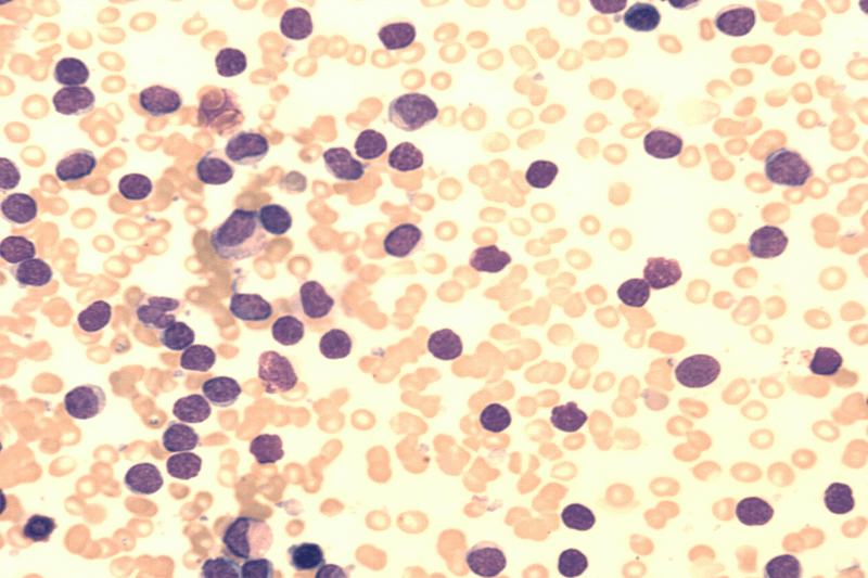  Leukemia